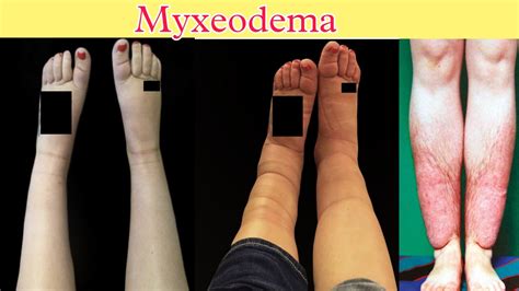 myxoma|myxedema signs and symptoms.